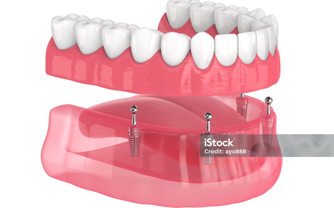 Hoe kiest u de juiste tandprotheticus voor uw behoeften